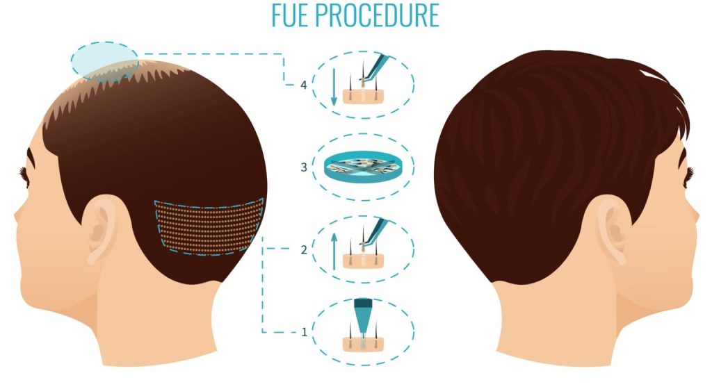 زراعة الشعر بتقنية DHI